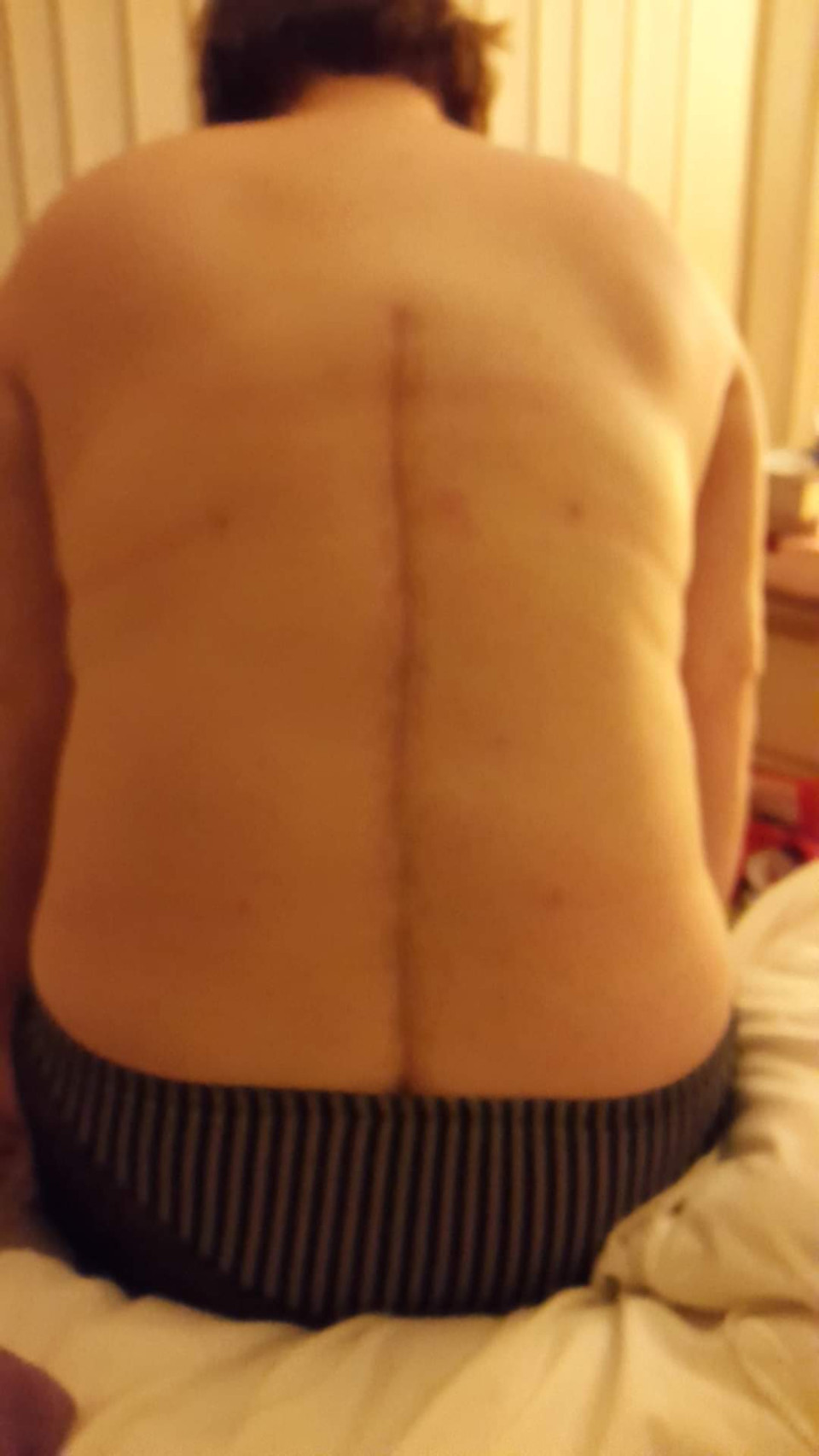 My scar from surgery, was asked about it the other day.
